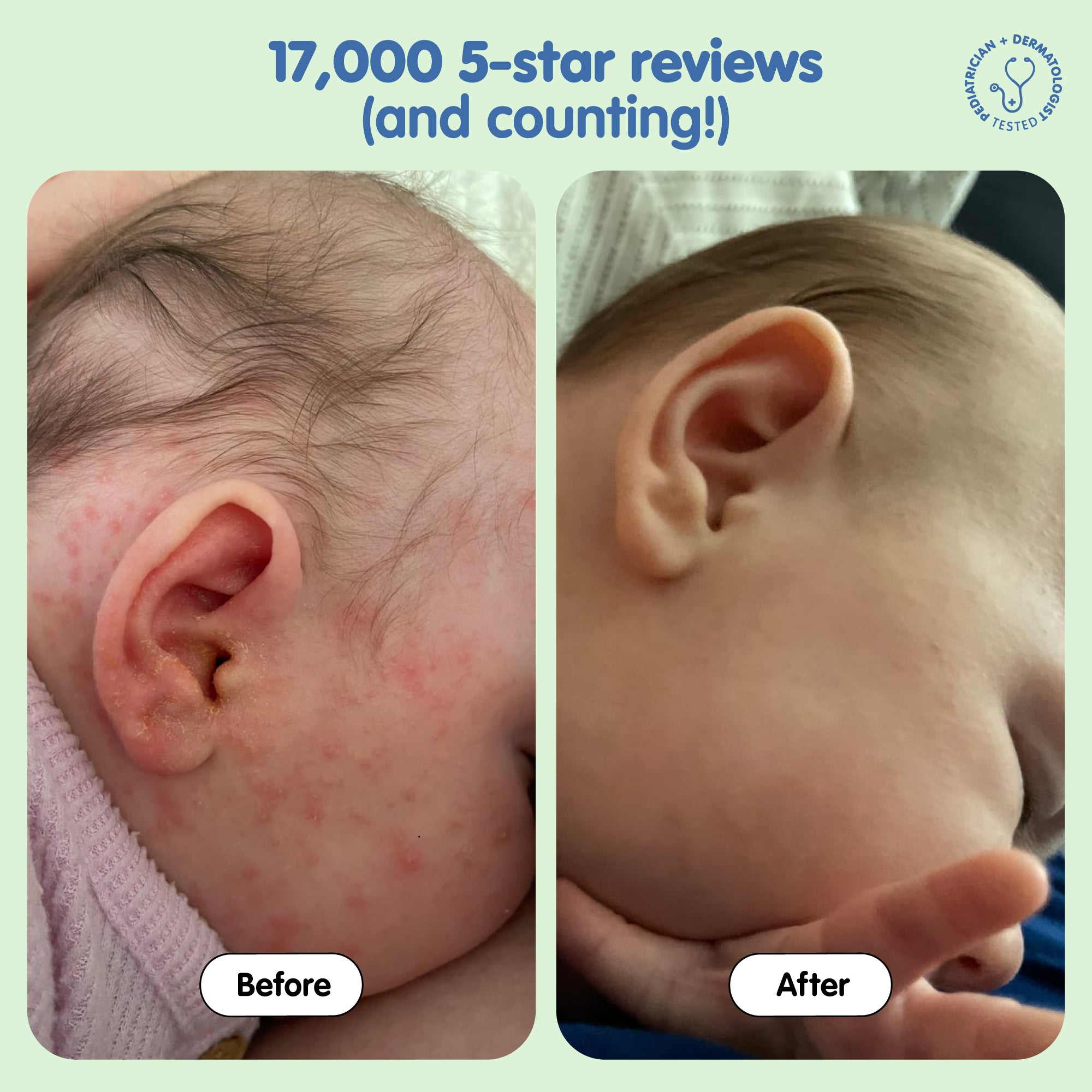 AOO 17,000 5- Star reviews (and counting!). Pediatrician + Dermatologist Tested. Before and After photos of a baby with left photo showing baby's cheek covered in red bumps and in the right the same baby but the cheeks are cleared up.